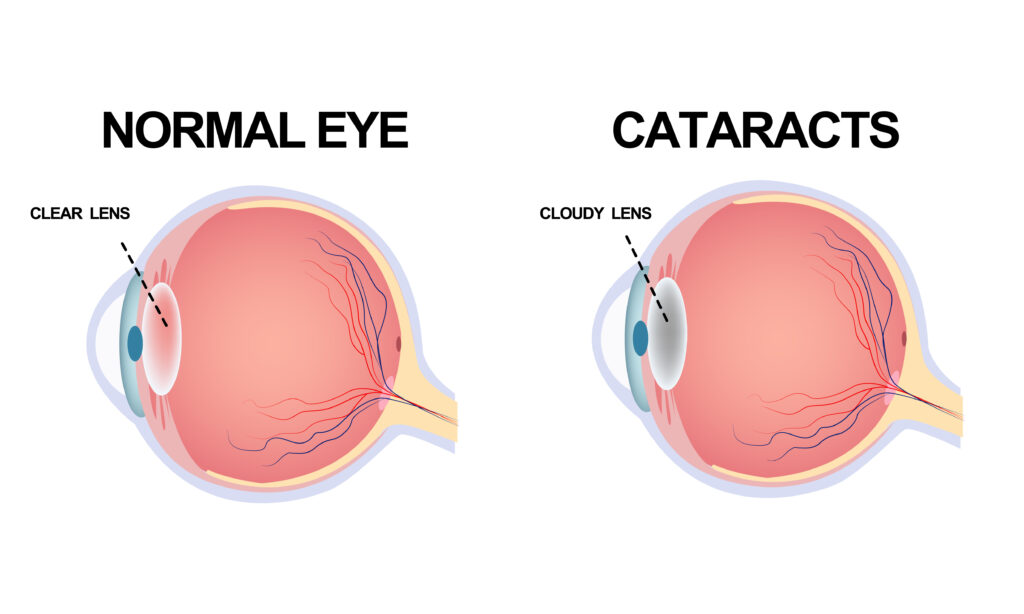 The structure of the eye. Cataract.