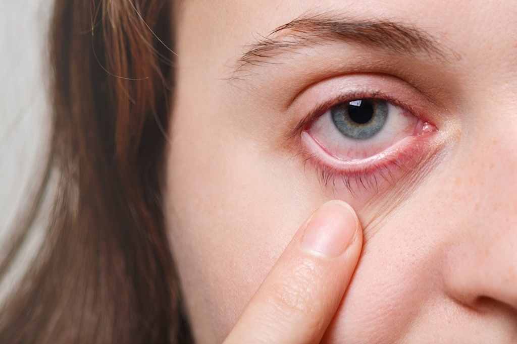 a girl has thin corneas